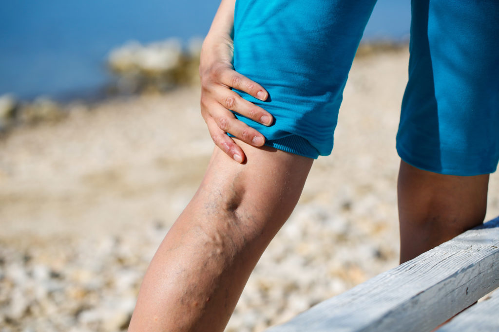 everything you need to know about varicose veins