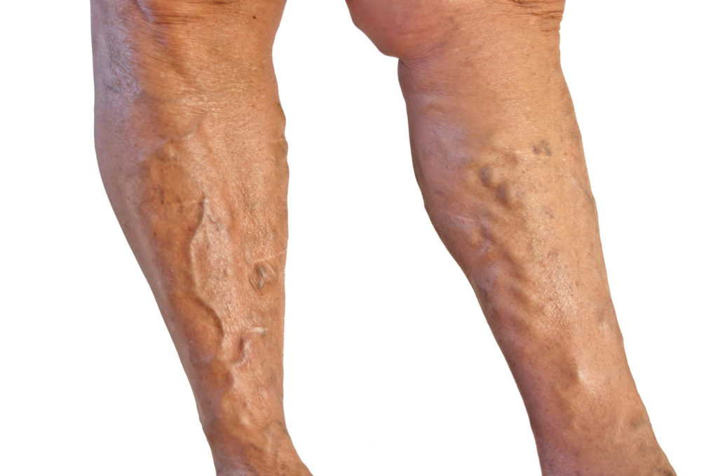 varicose veins causes