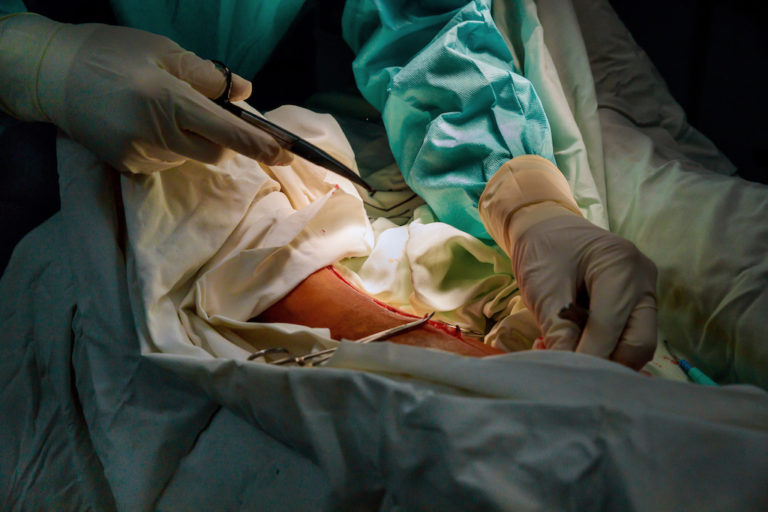 varicose veins surgery