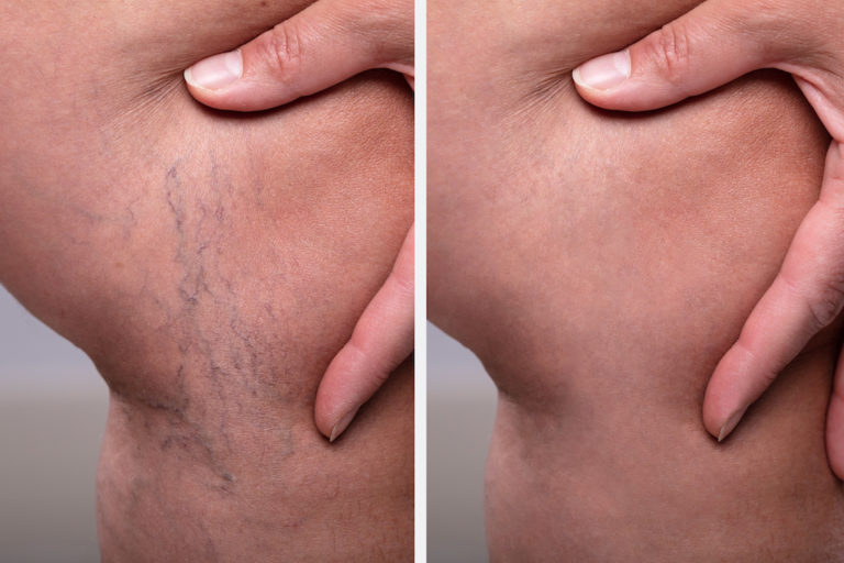 varicose veins laser treatment grand junction