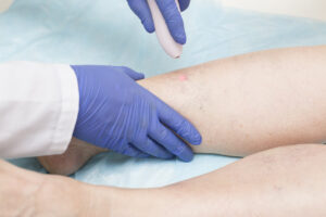 is laser vein treatment right for me