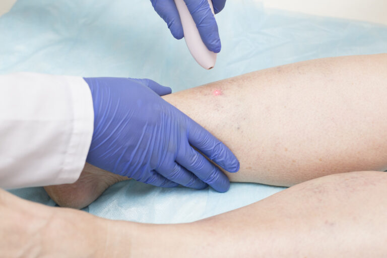 laser vein treatment