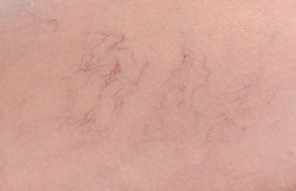 spider veins under the skin