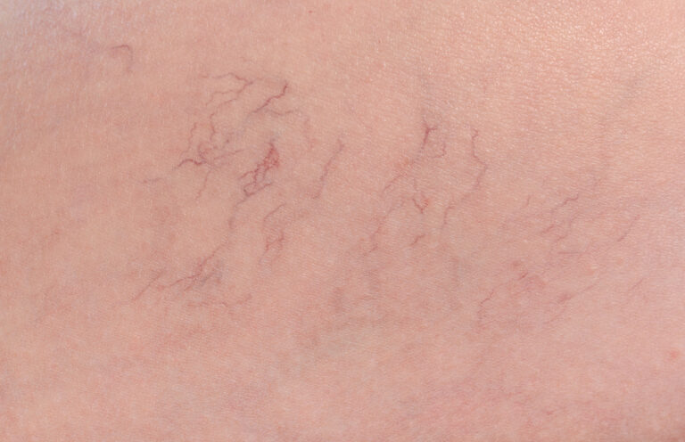 spider veins under the skin