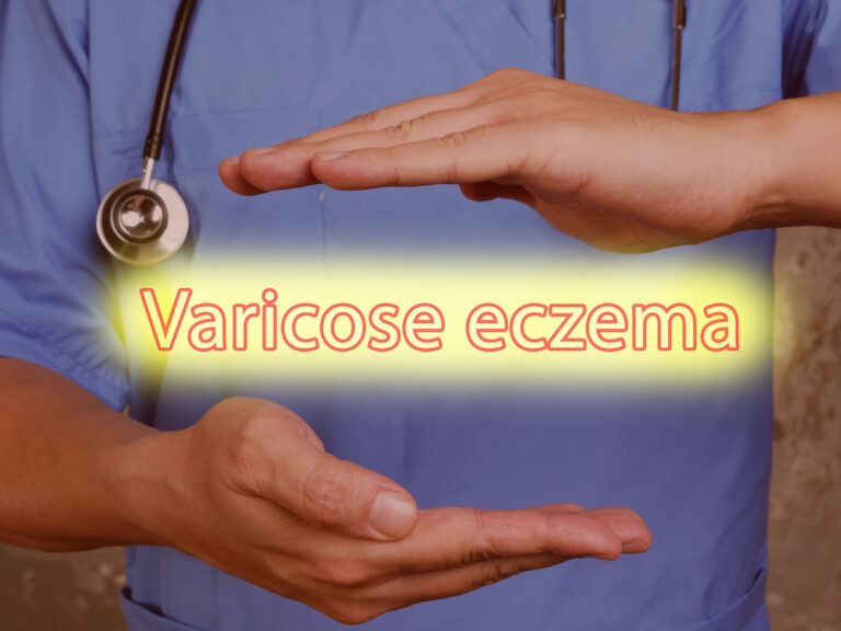 varicose eczema