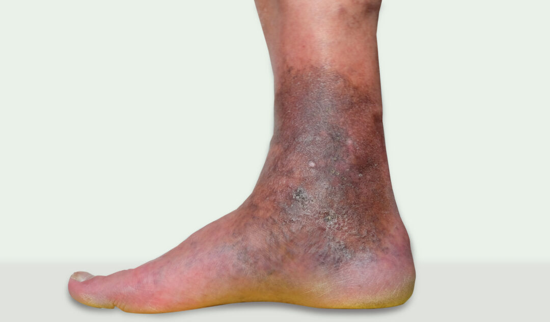 varicose eczema on ankles