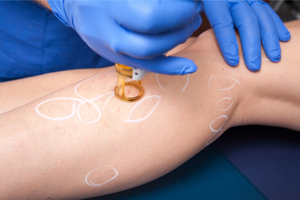 varicose vein treatment grand junction co