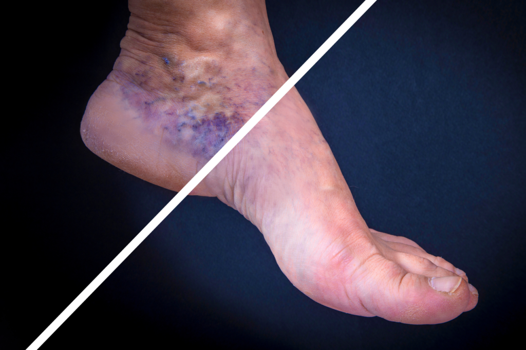 you need to treat varicose veins photo of foot with and without varicose veins
