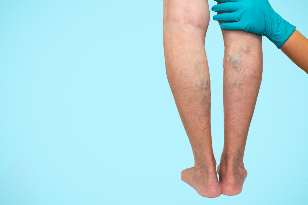 image demonstrating cost for varicose vein treatment by showing a legs with varicose veins being examined by vein specialist