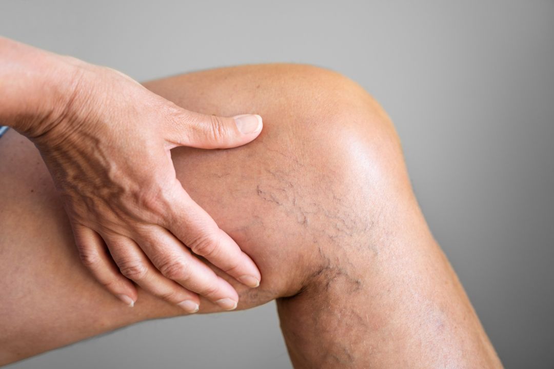 varicose vein pain relief