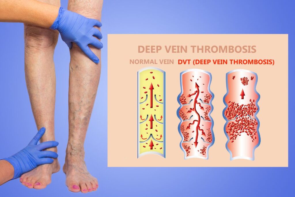 Deep Vein Thrombosis Awareness